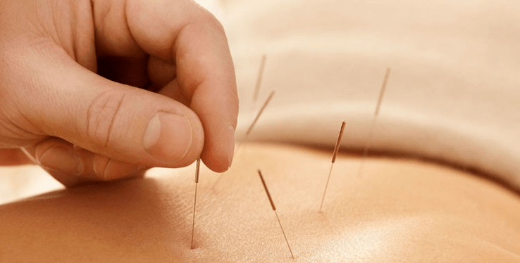 sigaraya karşı akupunktur